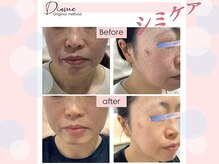 ディアメ(Diame)/密かに大人気♪シミケア