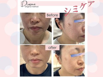 ディアメ(Diame)/密かに大人気♪シミケア
