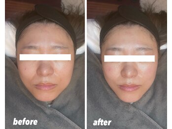 ウルラ(ULULA)/不動の人気ULULAの【小顔ケア】