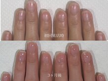 クラウドナイン(Cloud Nine)/3ヶ月で深爪のお悩み解決♪