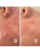 ハズキ(HAZUKI)/敏感肌の改善ならコレ/ハーブ