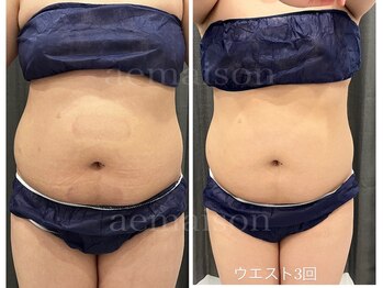 アエ メゾン(ae maison)/ウエスト3回後