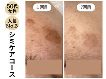 ディレイア ザ コスメ 有楽町マルイ店(direia the cosme)/シミ/くすみ/月1回［有楽町］