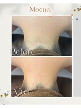 モエナ 武蔵小杉(Moena.)/襟足脱毛/うなじ