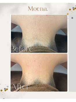 モエナ 武蔵小杉(Moena.)/襟足脱毛/うなじ