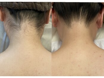 グラント(grant)/【全身脱毛】うなじ