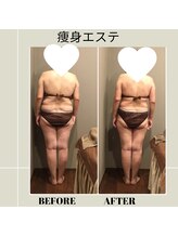 ムーン(MOON)/痩身エステbefore→after