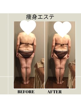 ムーン(MOON)/痩身エステbefore→after