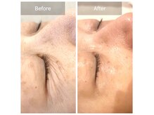 【1回施術の効果】シワ改善！凸凹肌*毛穴*艶肌