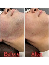 トミー(TOMMY)/Before＆After