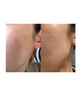 ソラ(SORA)/シミ改善