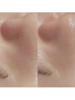 マイフェアレディ 今池(MyFairLady)/毛穴洗浄☆ハイドロフェイシャル