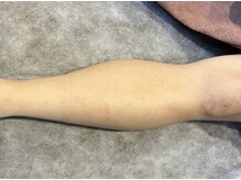 ヨハク(YOHAKU)/40代前半　男性　9回施術after