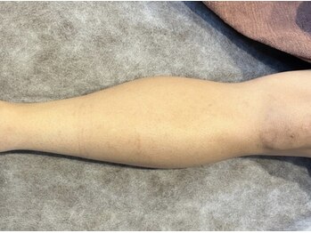 ヨハク(YOHAKU)/40代前半　男性　9回施術after