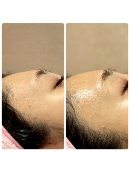 ミヨン ヨコハマ(Miyonne Yokohama)/LDM Aqua+小顔ヘッドスパ上大岡