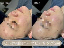 ハジュ(HAJU.)/肌荒れ、赤み、ニキビも改善