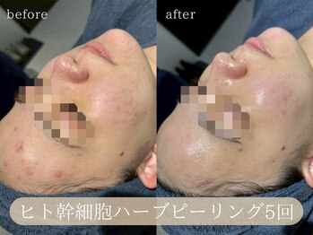 ハジュ(HAJU.)/肌荒れ、赤み、ニキビも改善