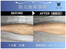 メンズビービー 福井高柳店(MEN'S BB)/ボディ脱毛施術事例