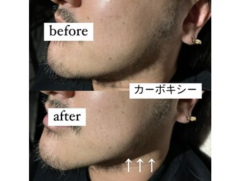 フリーク バイ シュリット 渋谷(fleek! by schritt)/【強炭酸カーボキシーパック】