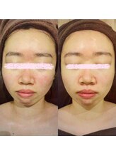 アユアランリンク 札幌店/1ヵ月でなめらか肌に！