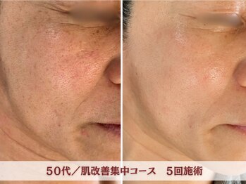 アリィ エステティック(allie esthetic)/【肌改善集中コース】