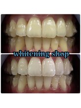 ホワイトニングショップ 大阪玉造店/Before&After美白ホワイトニング