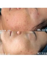 リーブル(LIBRE)/肌質改善