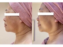 ビジュー(bijou)/50代のお客様/小顔/よもぎ蒸し/