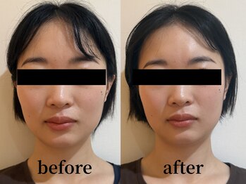 たたら鍼灸整骨院/30代女性 &nbsp;before / after