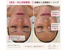 リミープラス 豊中曽根店(Re:Me+)の雰囲気（肌トラブルを徹底改善【赤み、敏感肌.乾燥肌,脂性肌.毛穴ケア】）