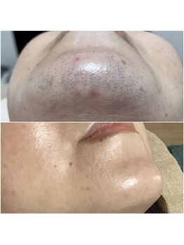 ワイエス サロン 東陽町(Ys Salon)/お顔の脱毛もお任せください