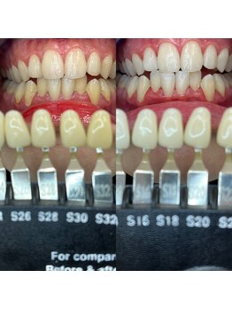 トウキョウスワーズ 池袋店(TOKYO SWRS)/#ホワイトニング #池袋 #渋谷