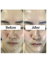 ル ボヌール 伊那店(le bonheur)/シミを固めて排出