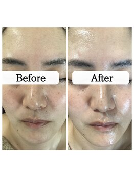 ル ボヌール 伊那店(le bonheur)/シミを固めて排出