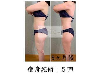 アイ エステサロン(Ai)/【40代】痩せれた!