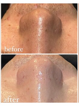 ルタンリッシュオム(Lutan Riche hom)/毛穴洗浄もできる!