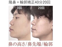 ラプリ 梅田店(Raplit)/隆鼻＋輪郭矯正40分20回