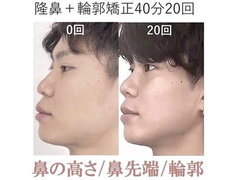 ラプリ 梅田店(Raplit)/隆鼻+輪郭矯正40分20回