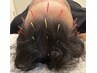 【血流リセット頭皮鍼灸×全身調整】頭皮のコリをほぐし、頭皮の血行改善