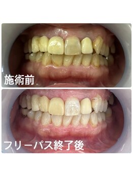 ホワイトニングサロン 京都烏丸店/ホワイトニング施術例