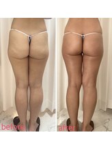 美バストアルファ(美bust α)/【ヒップアップ】症例