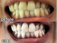 グラーティア 梅田店(gratia)/ホワイトニング★9回目★