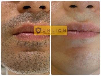 アン リオン(UN LiON)/顔全体12回