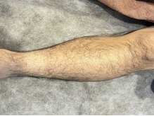 ヨハク(YOHAKU)/40代前半　男性　9回施術before