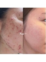 リベルテ(Liberte)/セレクトニキビケア管理