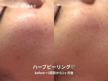 ピブ(pib.)/ハーブピーリング｜ニキビ/赤み