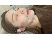 かがやき整体院 十三/美容鍼