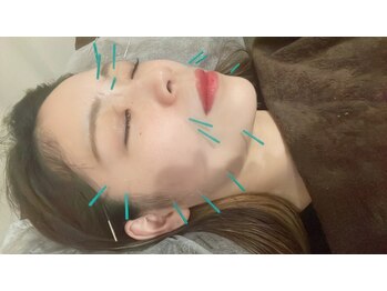 かがやき整体院 十三/美容鍼