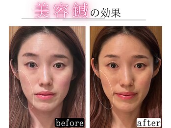 栄光治院 岡崎本院/ひと目でわかる美容鍼の効果!