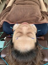 ハリファ鍼灸院 横浜関内院(HariFa鍼灸院)/美容鍼施術/美容鍼